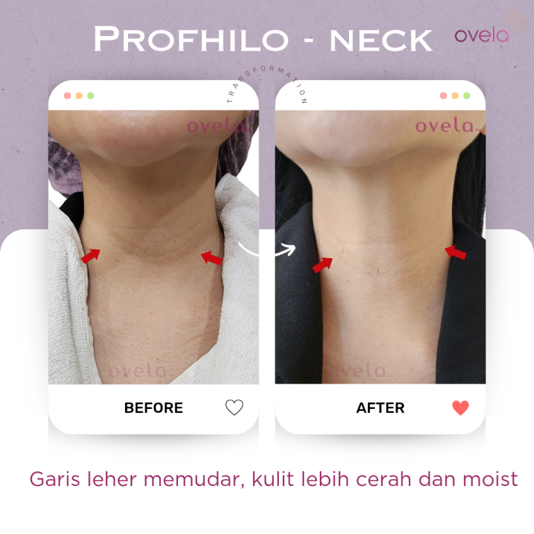Before and after Profhilo treatment for improved skin hydration and firmness at Ovela Clinic Jakarta