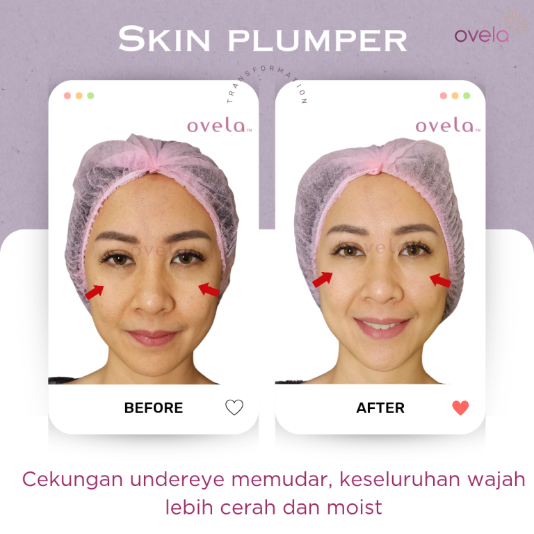 Before and after skin booster treatment for hydrated and glowing skin at Ovela Clinic Jakarta