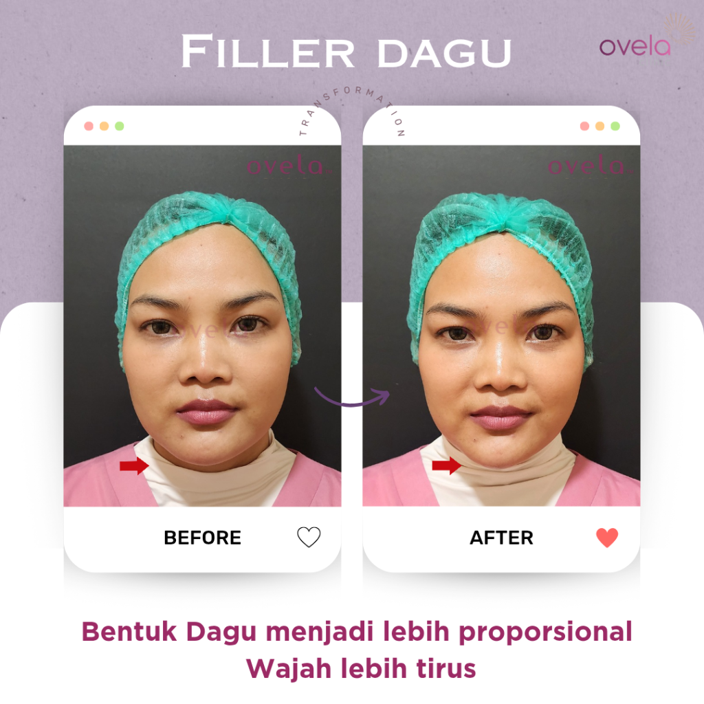 Before After Filler Dagu