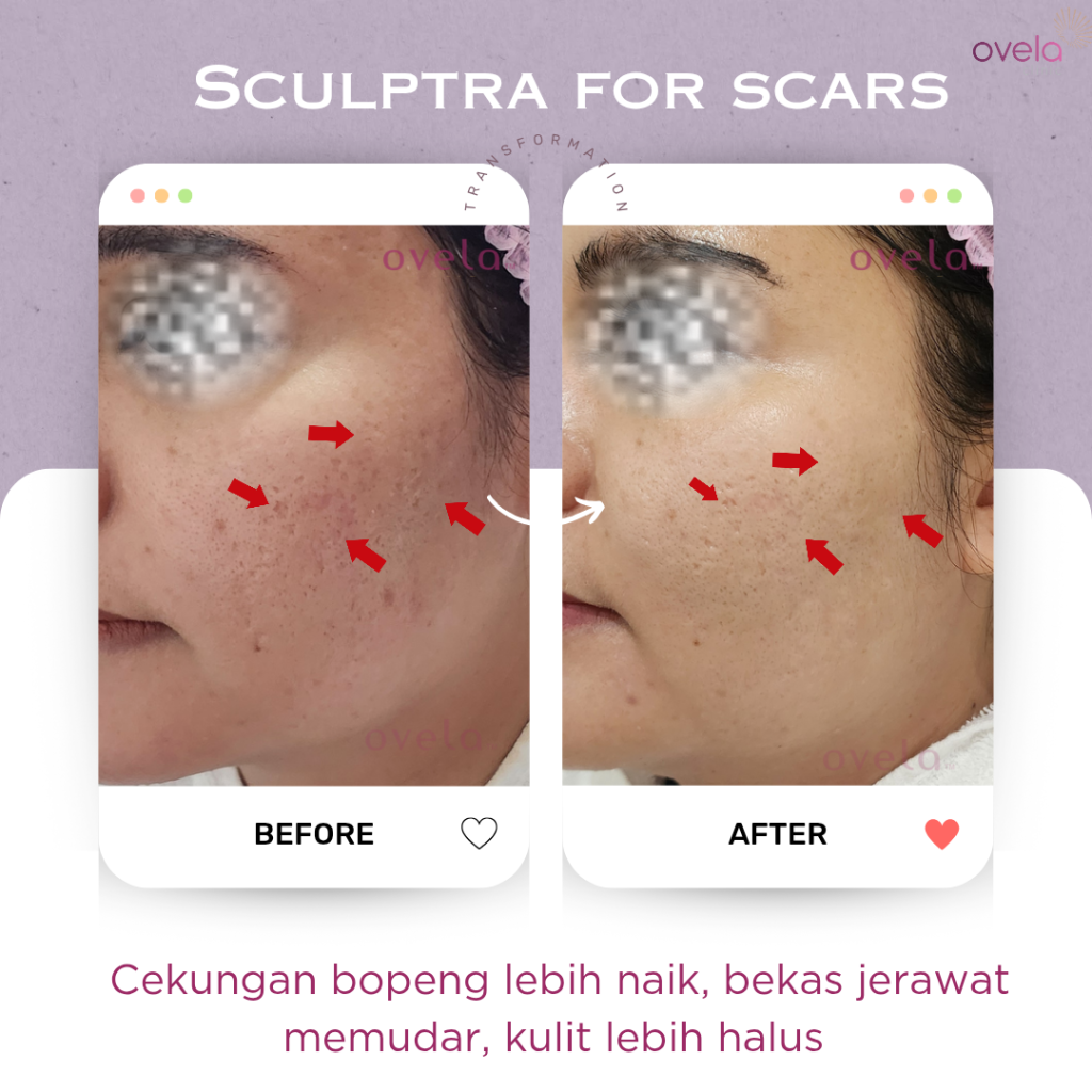 Before After Treatment Sculptra di Ovela Clinic