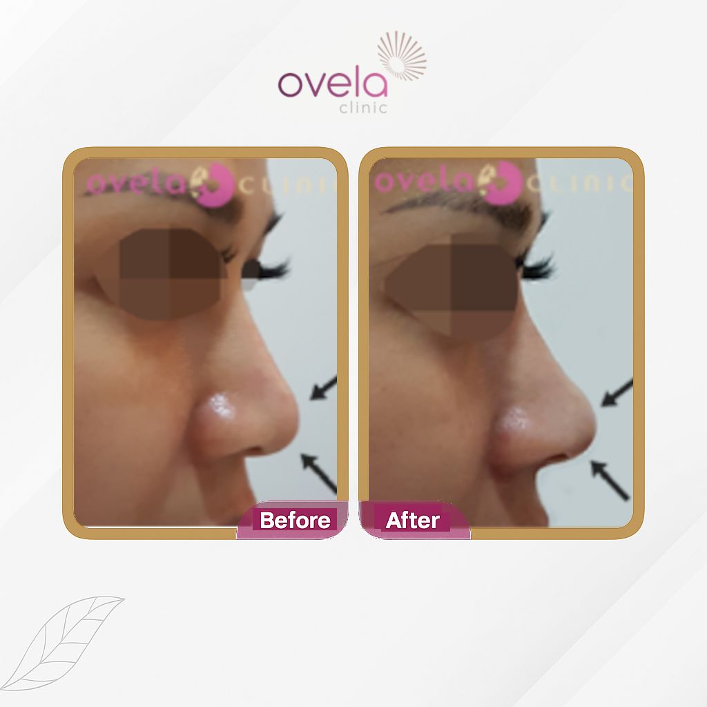 After Tanam Benang PDO