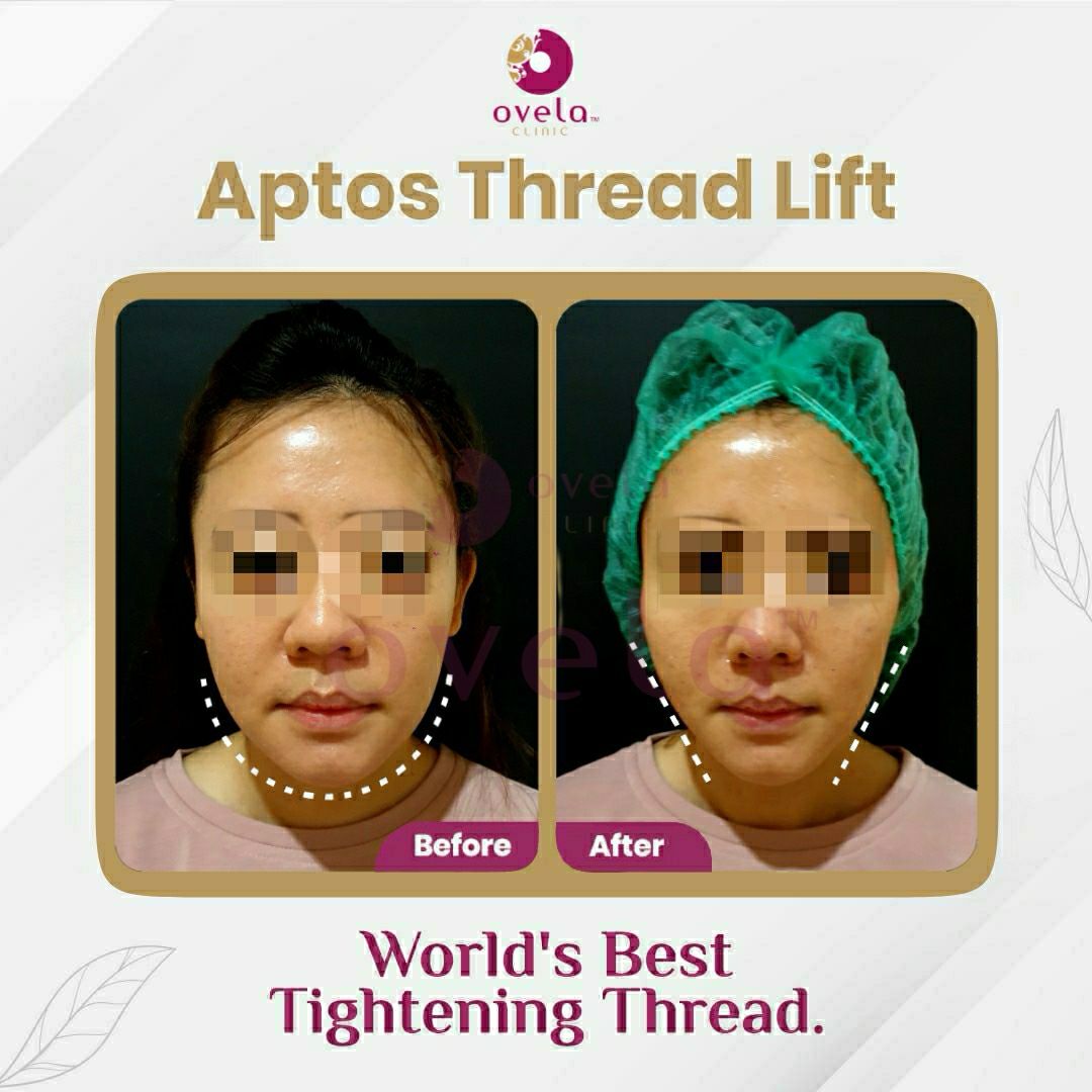 After Aptos Thread Lift