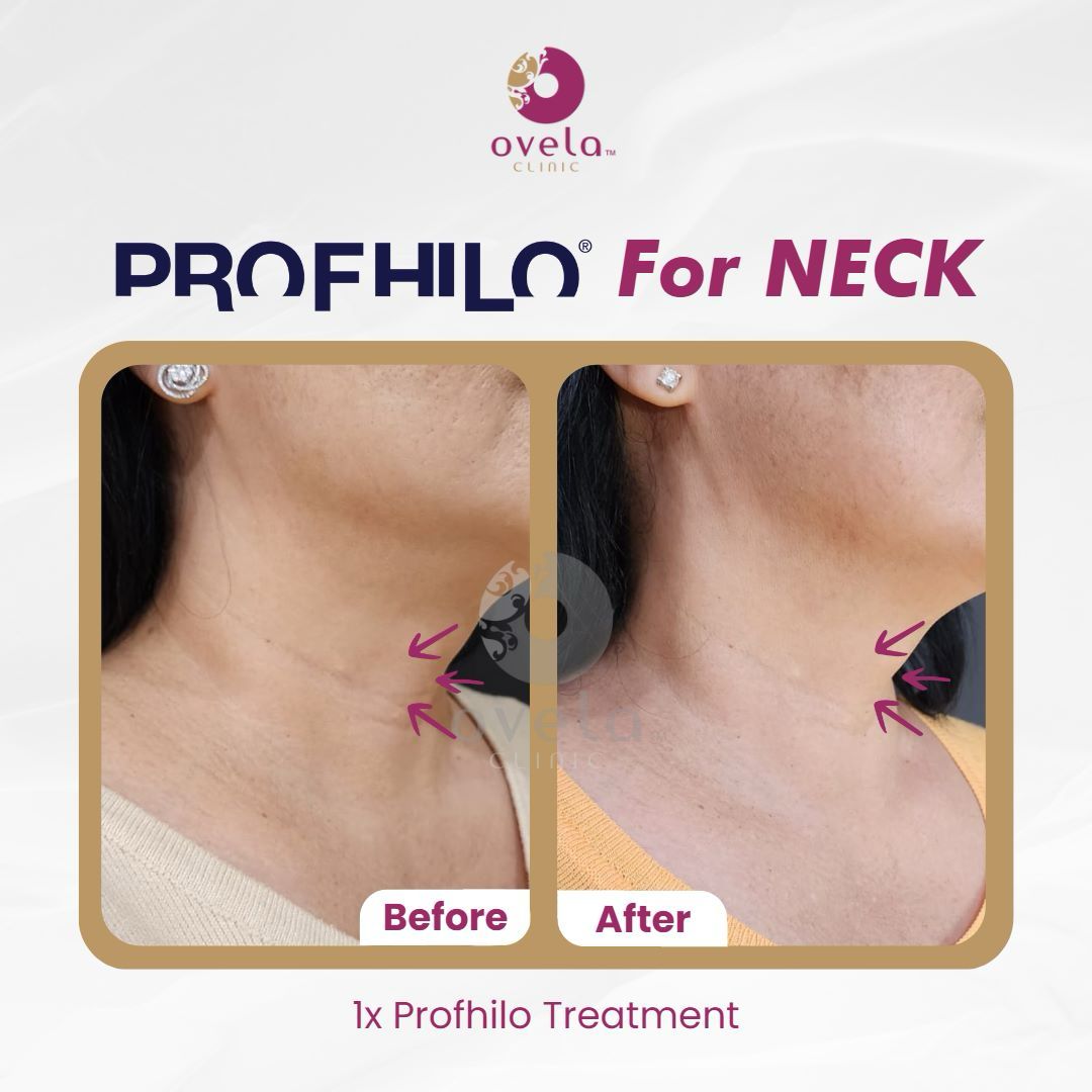 After Profhilo For Neck