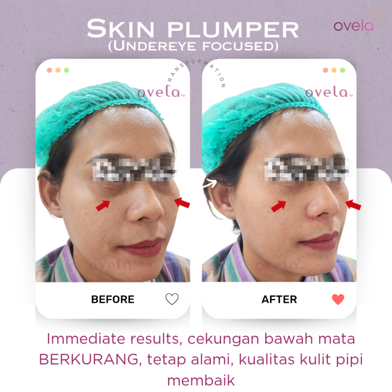 Before after Skin Booster di Ovela Clinic Jakarta untuk membantu meningkatkan hidrasi dan kualitas kulit