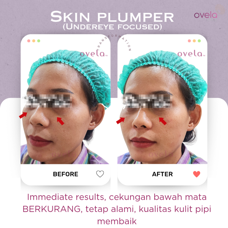 Hasil treatment Skin Booster di Ovela Clinic Jakarta dengan kulit tampak lebih lembap dan glowing