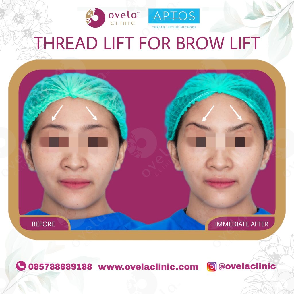 Hasil Aptos Thread Lift pipi tampak depan di Ovela Clinic Jakarta