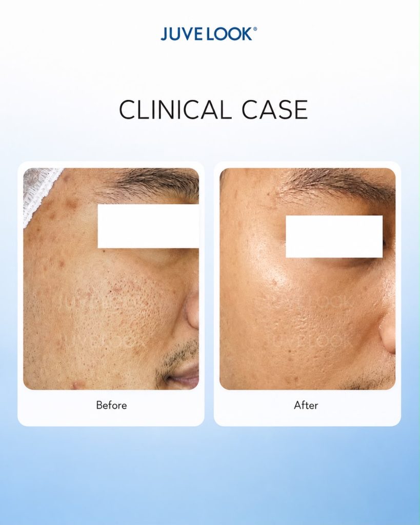 Before and after treatment Juvelook yang menunjukkan perubahan kualitas dan tekstur kulit