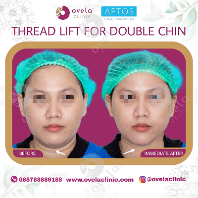 Before - After
