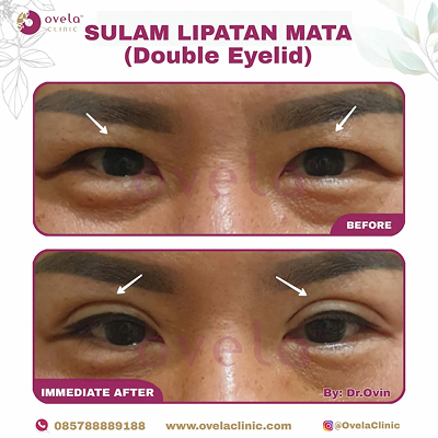 Before - After