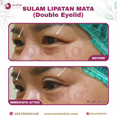Before - After