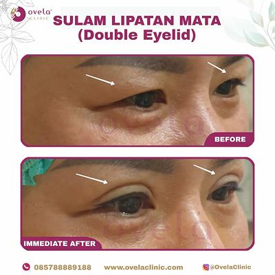 Before - After