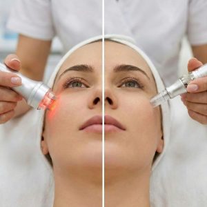 microneedling vs microneedling rf