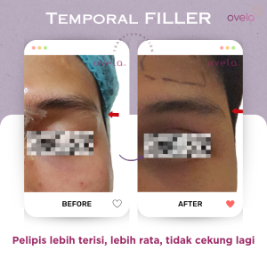 foto before atfer filler pelipis 