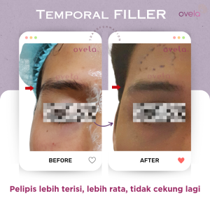 Before after filler pelipis di ovela clinic