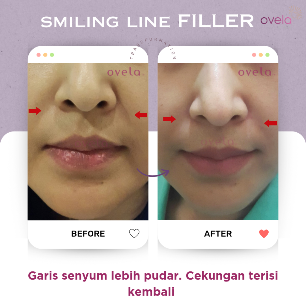 Before and after nasolabial fold filler treatment at Ovela Clinic Jakarta