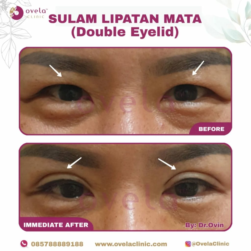 Before after sulam lipatan mata tampak depan di Ovela Clinic Jakarta