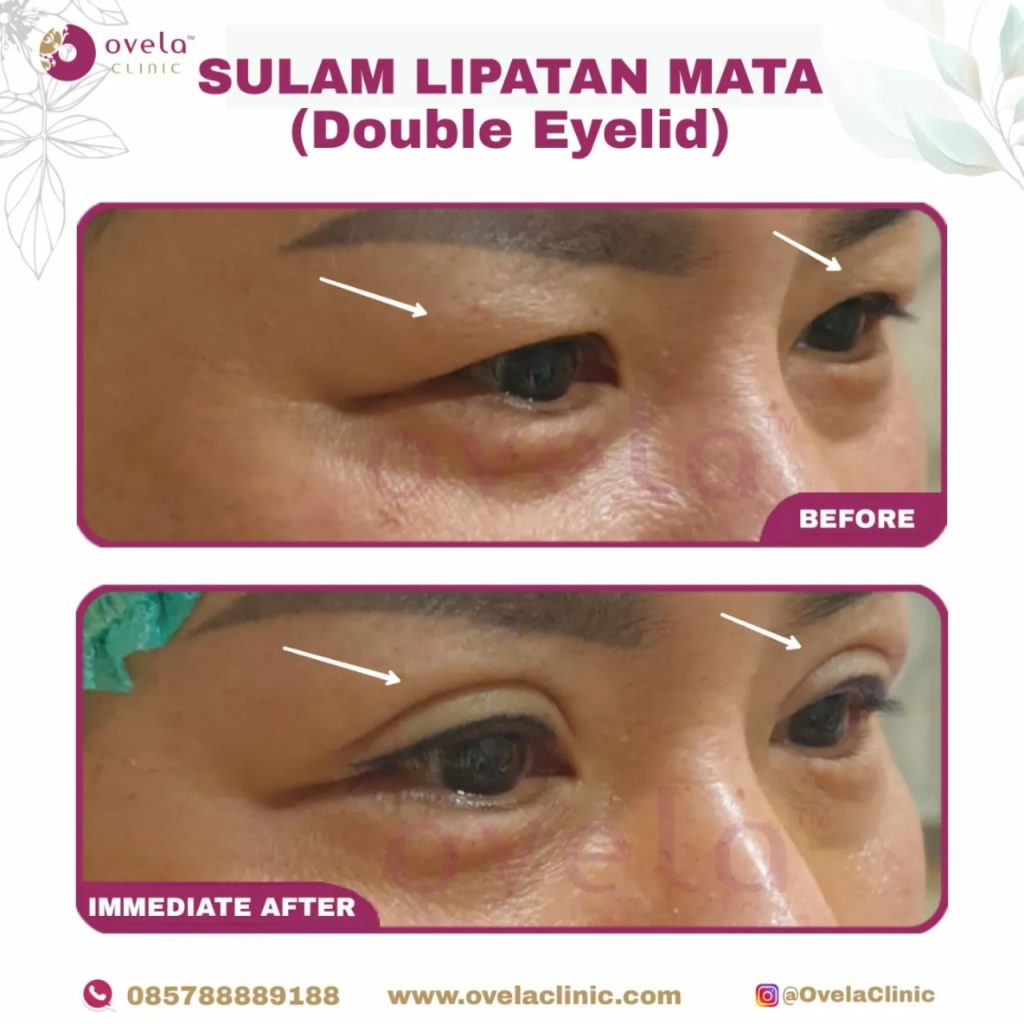Before after sulam lipatan mata tampak kanan di Ovela Clinic Jakarta