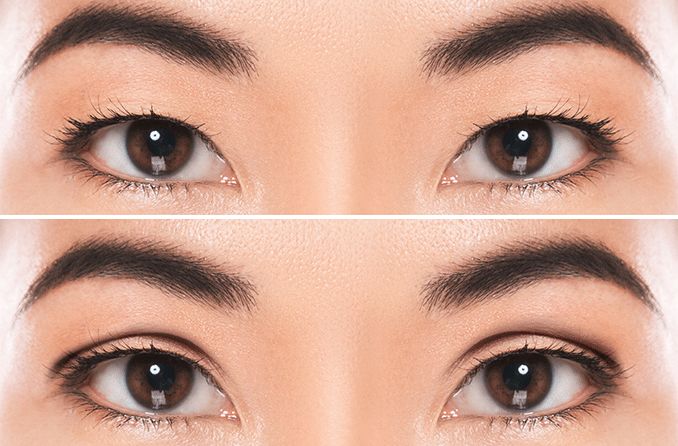 Treatment double eyelid di Ovela Clinic Jakarta
