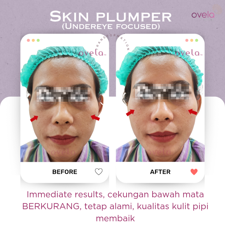 Before and after Skin Booster Jakarta di Ovela Clinic untuk perawatan skin quality