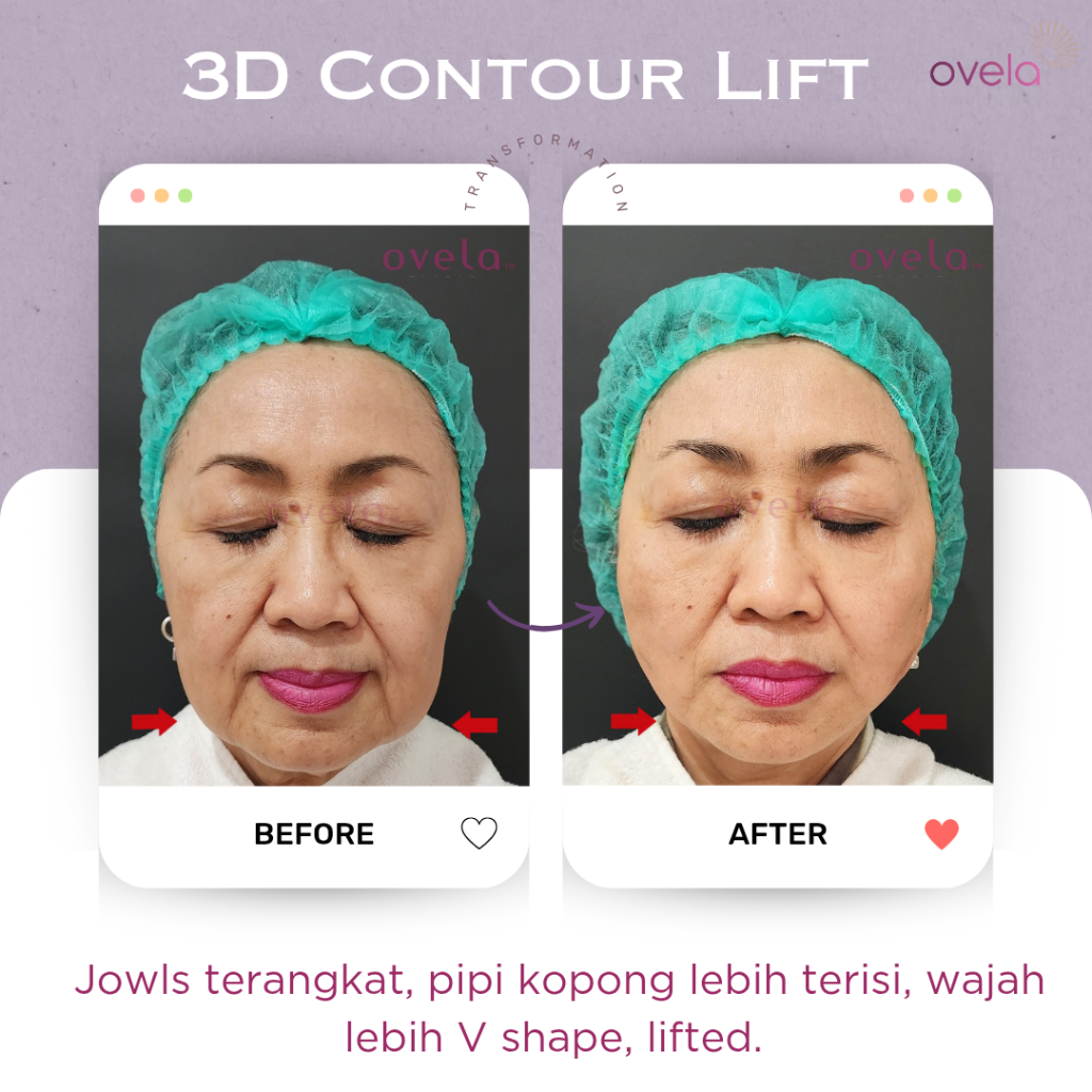 Before after tarik benang wajah Aptos Thread Lift di Ovela Clinic Jakarta tampak depan, menunjukkan perubahan kontur pipi bawah dan jawline.