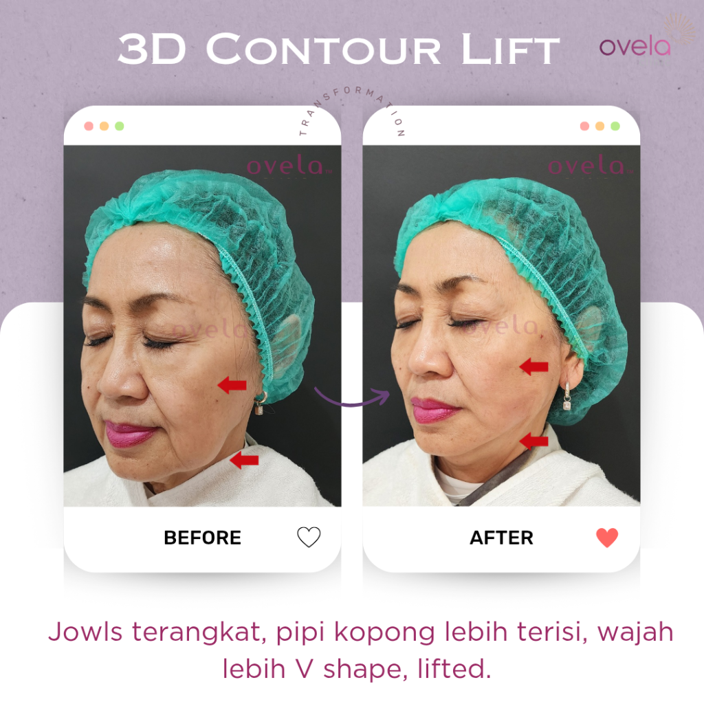 Before after tarik benang pipi Aptos di Ovela Clinic Jakarta dari sudut tiga perempat, memperlihatkan perubahan kontur pipi dan garis rahang setelah thread lift.